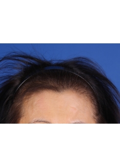 Before Hair Transplant&nbsp;Hair Thinning